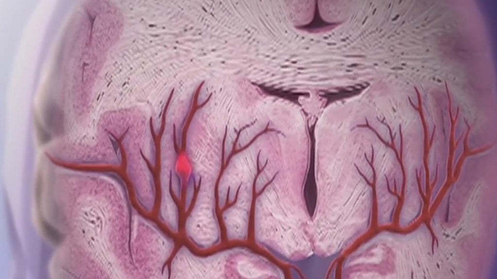 Knowing the signs of a stroke can save lives — Newnan Community news